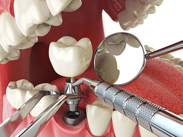 Best Emergency Treatment for Dental Infections or Abscesses in Dayton, VA